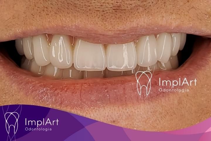 DOUBLE ARCH DENTAL IMPLANTS