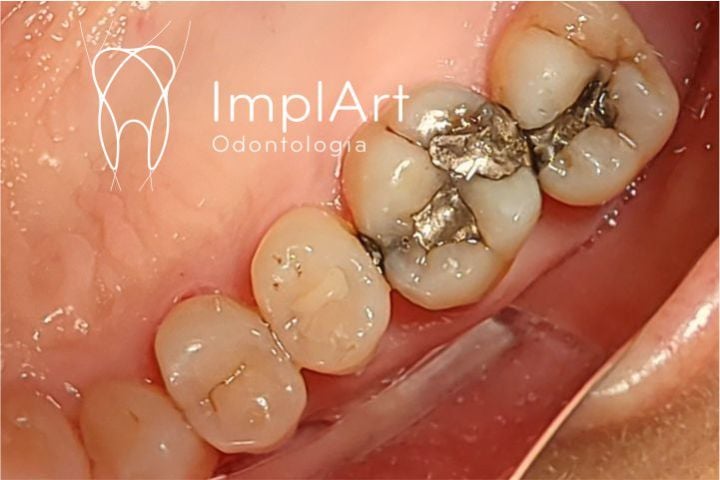 A remoção de restauração em amálgama pode expor a materiais contaminantes? restauração com amálgama