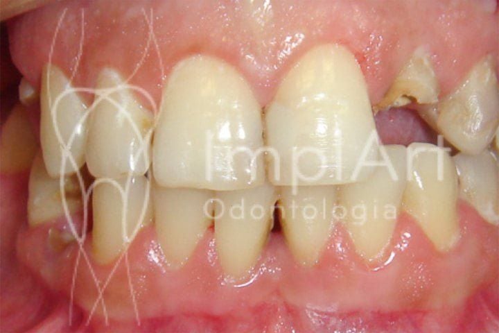 dente quebrado