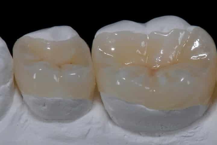 Restaurações estéticas - bloco em porcelana Bloco em porcelana