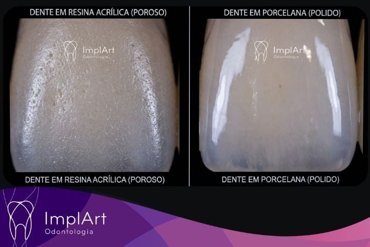 Prótese Protocolo em Resina ou Zircônia: o que ninguém conta (verdades que fazem diferença no seu implante dentário) protese protocolo resina
