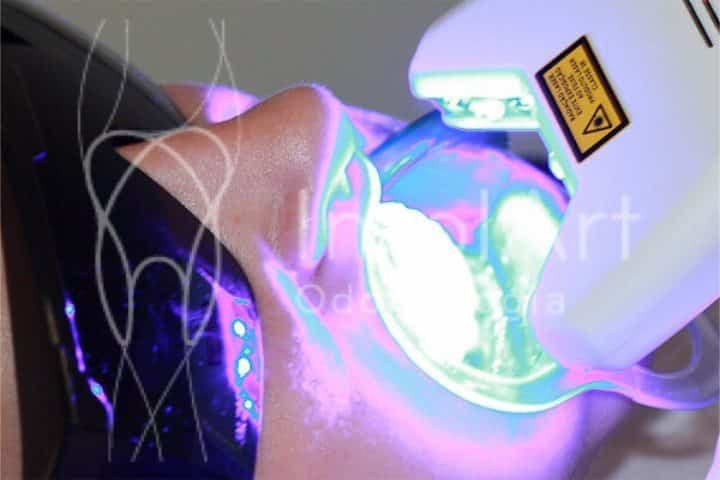 Clareamento dental a laser
