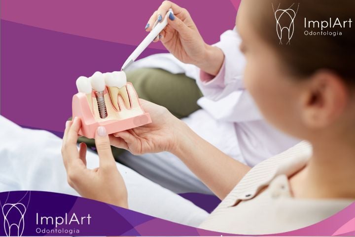 IMPLANTE DENTARIO COMO É FEITO? implante dentario como é feito