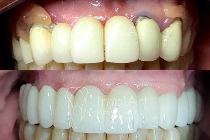 Pr&oacute;tese fixa em implantes
