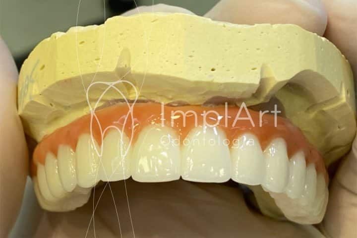 Pr&oacute;tese protocolo com implantes