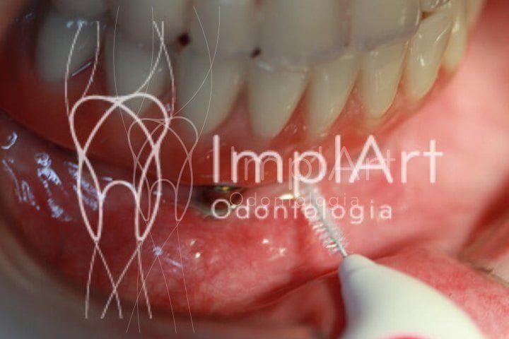 Como deve ser a limpeza diária prótese protocolo? limpeza