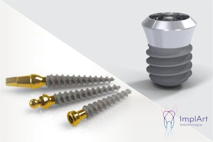 Implante dent&aacute;rio sem enxerto