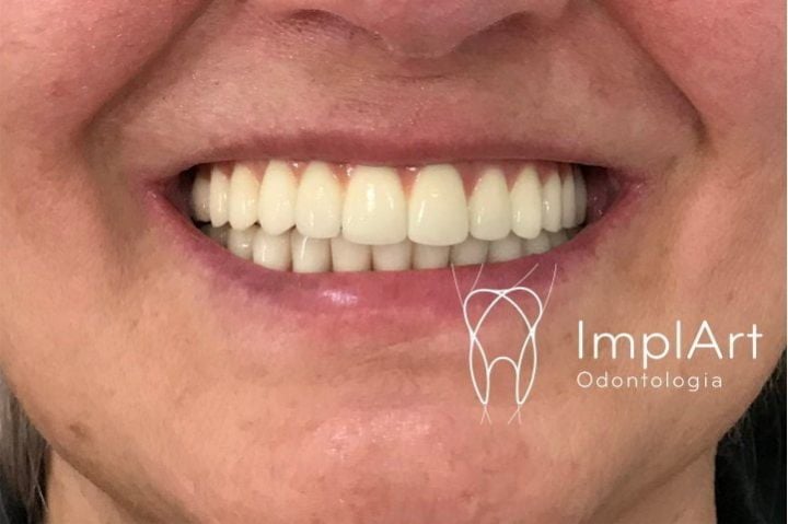 Zirconia is the Most Modern Material for Fixed Full-Arch Prosthesis with Dental Implants zirconia