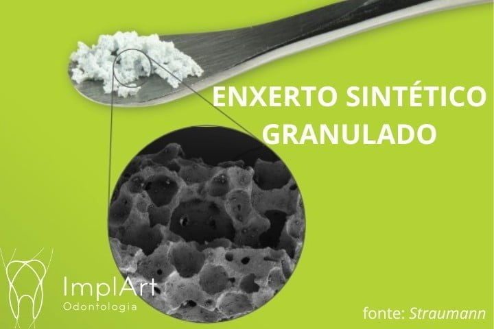 Enxerto ósseo: Pontinho branco na gengiva após fazer enxerto ósseo é um problema? enxerto ósseo granulado