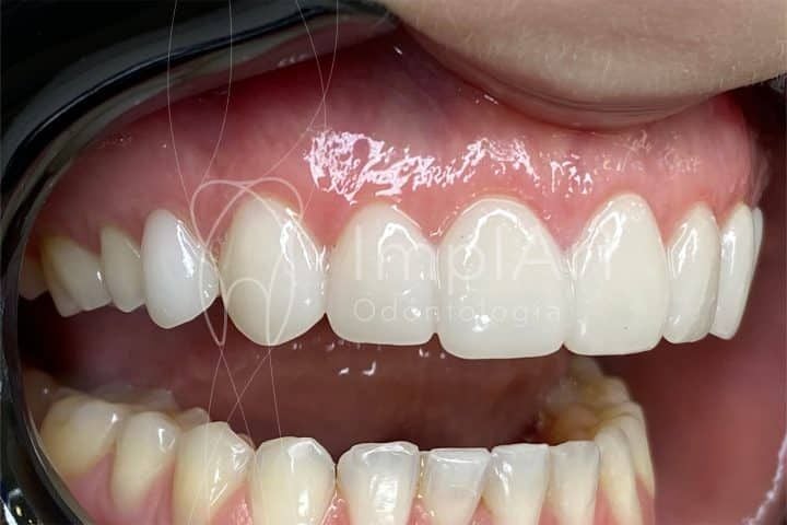 Precisa fazer desgaste dos dentes para lentes de contato dentais? desgaste dos dentes para lentes