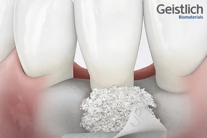 enxertos periodontais