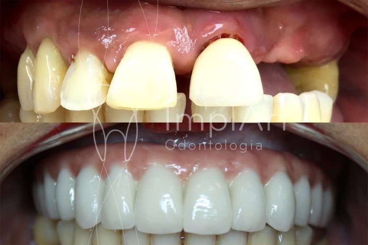 Implante dent&aacute;rio completo