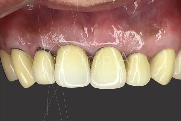 pr&oacute;tese em metal