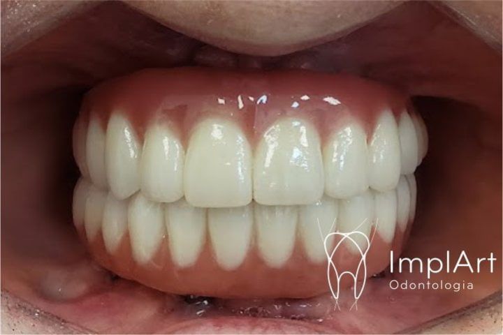 full arch dental implants