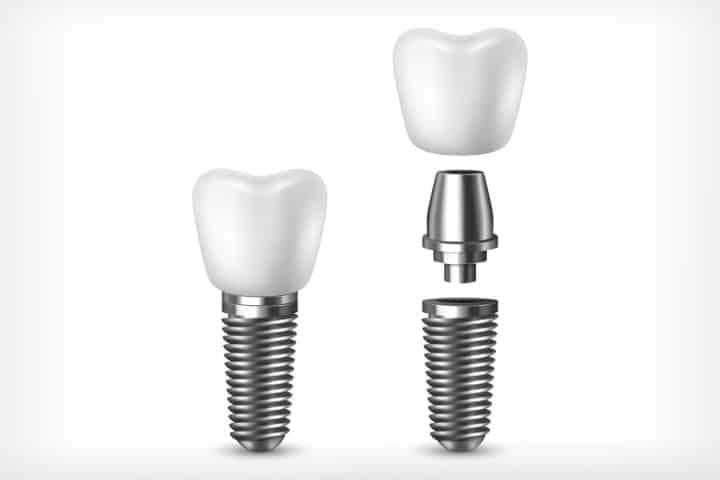 Implante total | Dúvidas frequentes implantes