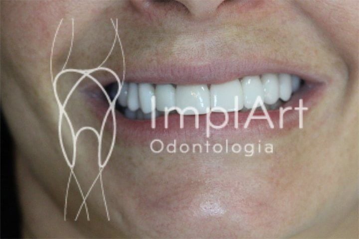 Porcelain veneers for a beautiful and attractive smile Porcelain veneers