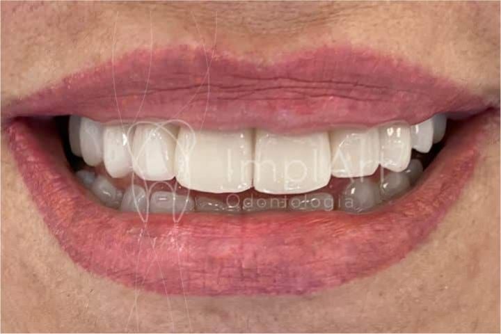 Metal-ceramic prosthesis for implants metal-ceramic