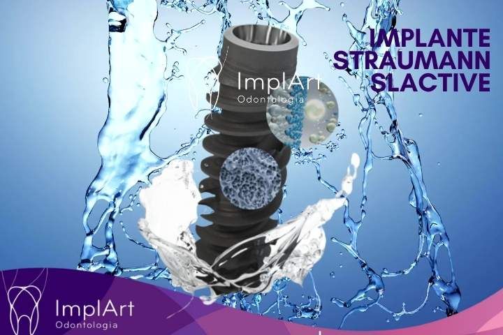 IMPLANTE SU&Iacute;&Ccedil;O STRAUMANN SLACTIVE NA IMPLART
