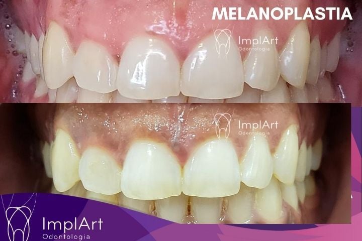 Melanoplastia: a cirurgia para clarear as gengivas melanoplastia