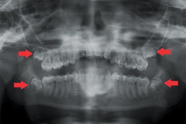Extração dos dentes do siso dentes do siso