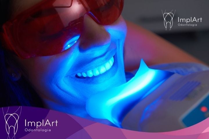 CLAREAMENTO DENTAL A LASER