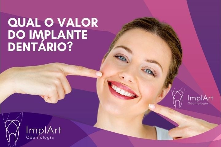 quanto custa um implante dentario